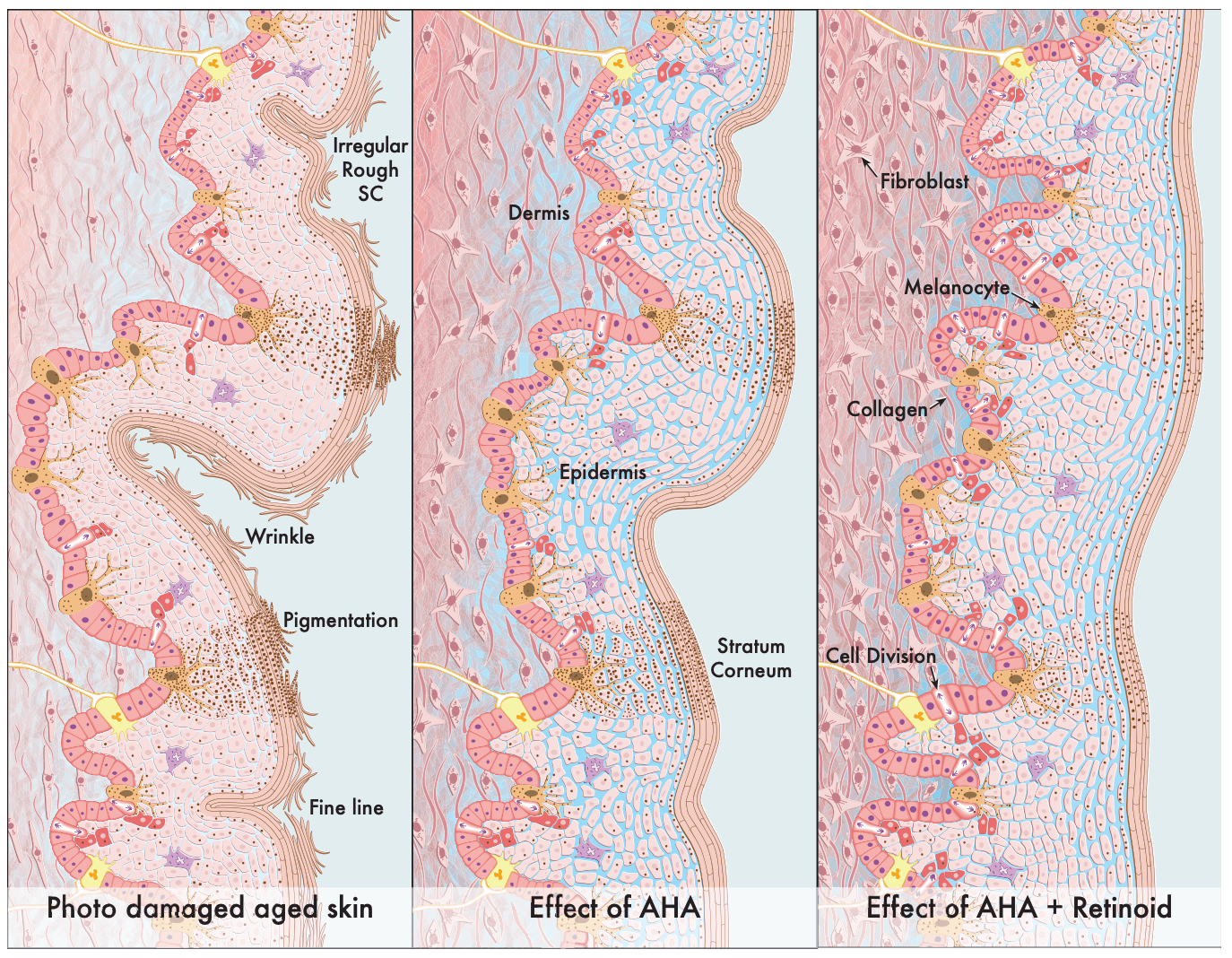 ダメージを受けた肌→AHAによる効果→AHAとレチノイドを組み合わせた効果